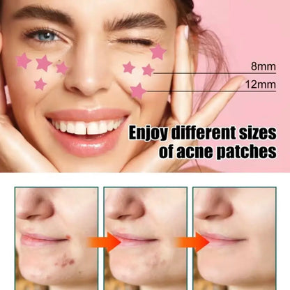 Pink Star Pimple Patches, Acne Spot Dots, 28 Count, Hydrocolloid, All Skin Types, Skincare, Skin Repair